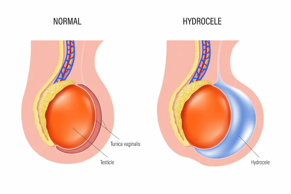 Hydrocele Feature