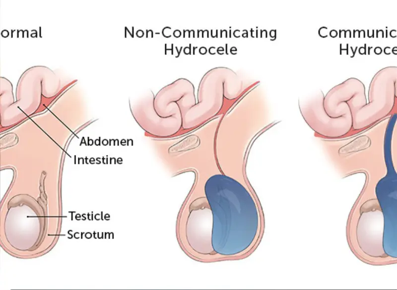 Hydrocele Step 3
