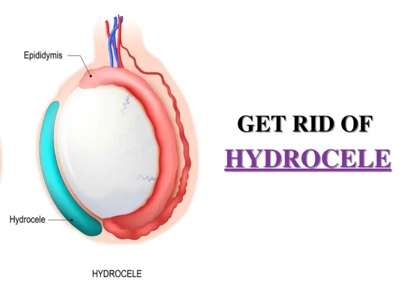 Hydrocele Step 4