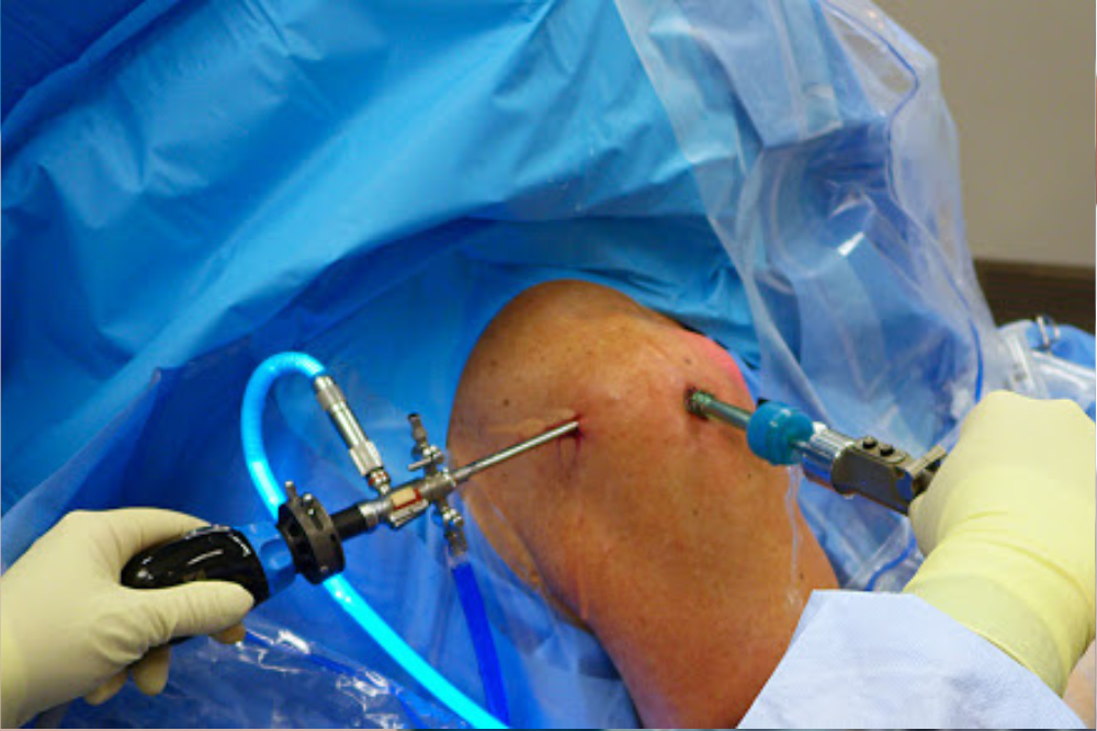 Arthroscopic or Open Surgery