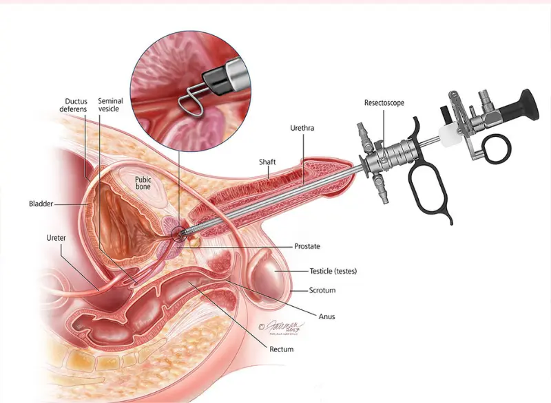 Enlarged Prostate Step 3