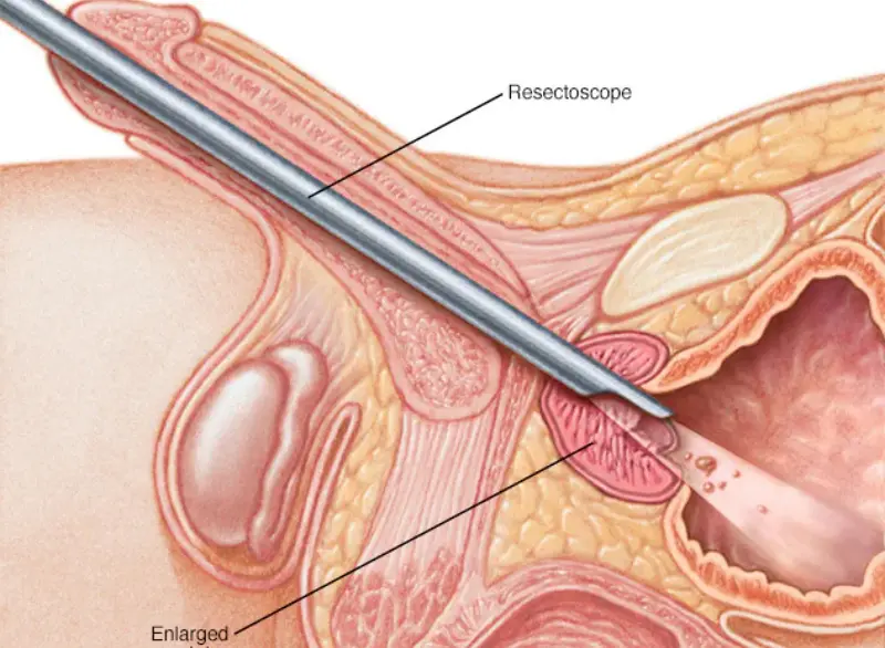 Enlarged Prostate Step 4
