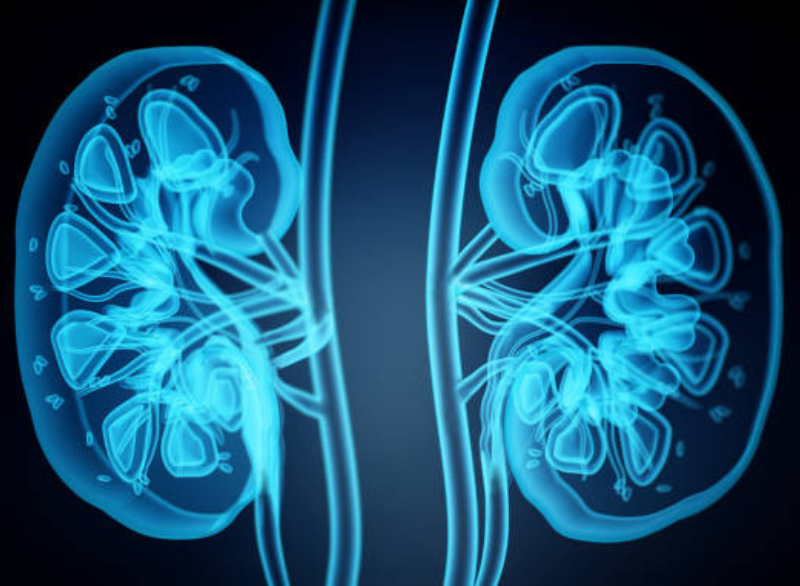 Kidney Stones Step 1