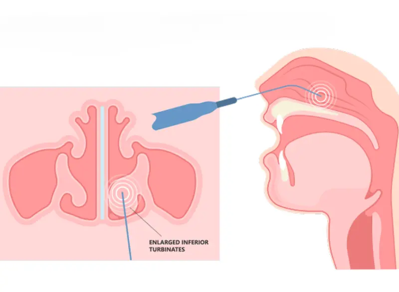 Turbinate Reduction Step 4