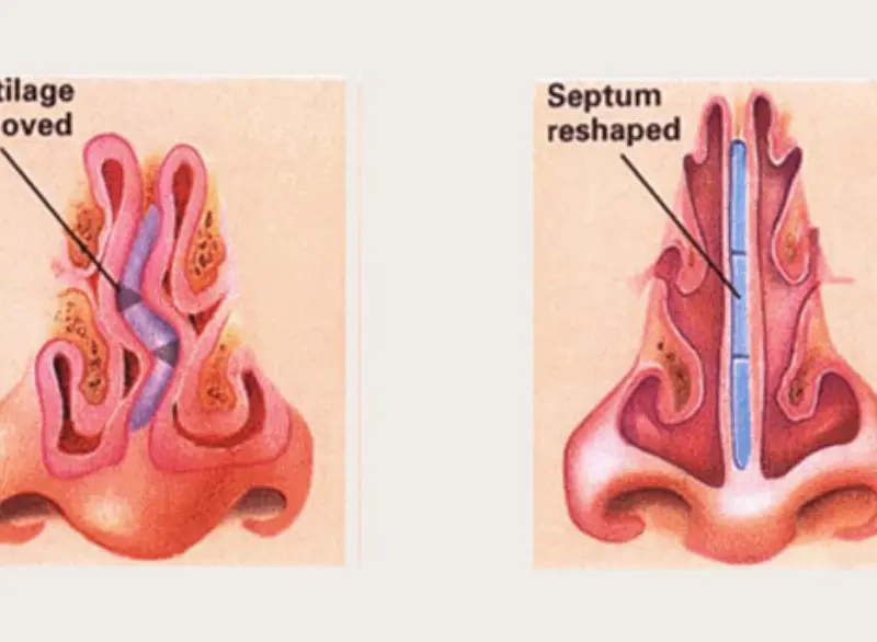 Turbinate Reduction Step 4
