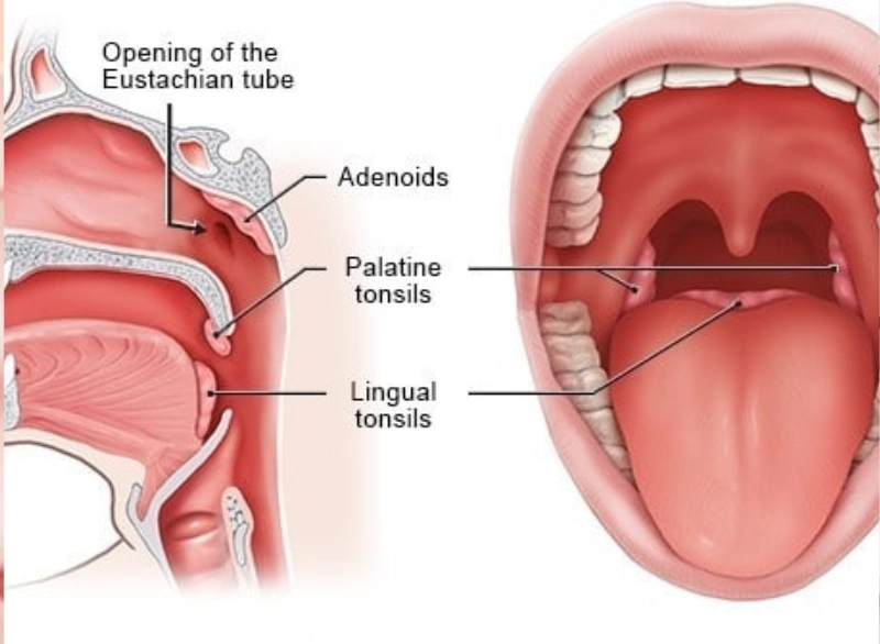 Tonsillectomy Step 2