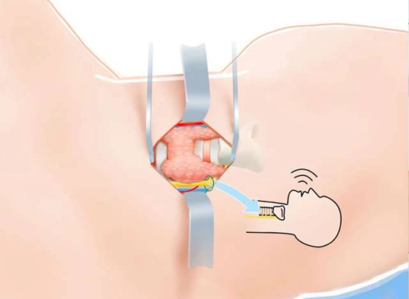 Thyroidectomy Step 3