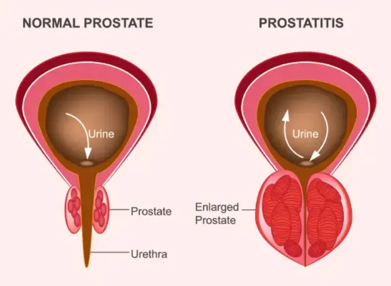 Enlarged Prostate Step 1