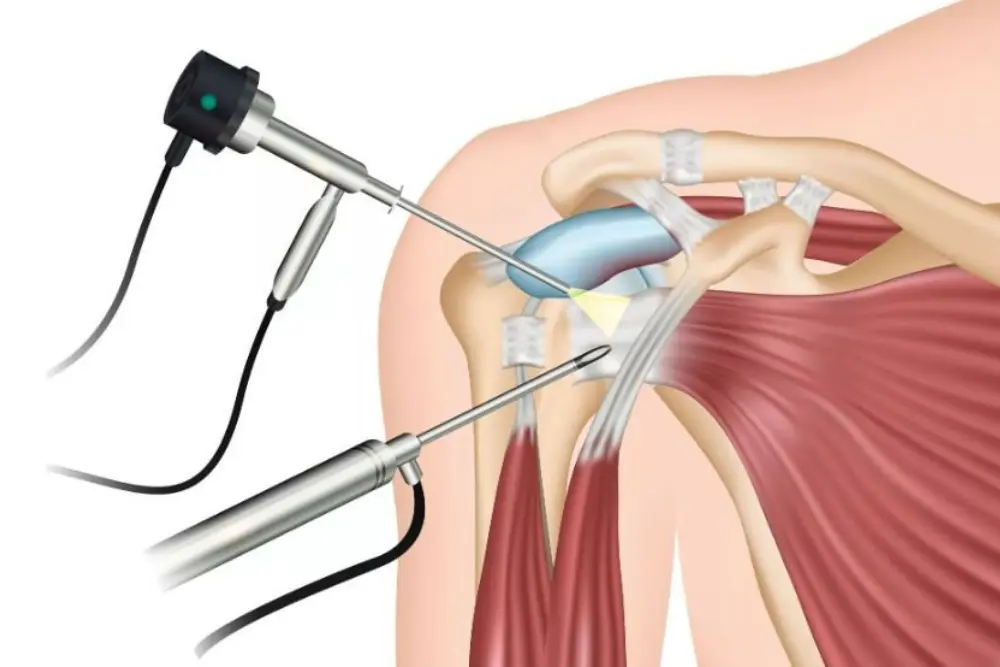 Arthroscopic Surgery