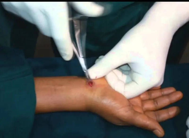 Carpal tunnel syndrome Step 3