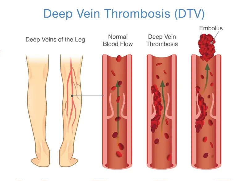 DVT Step 1