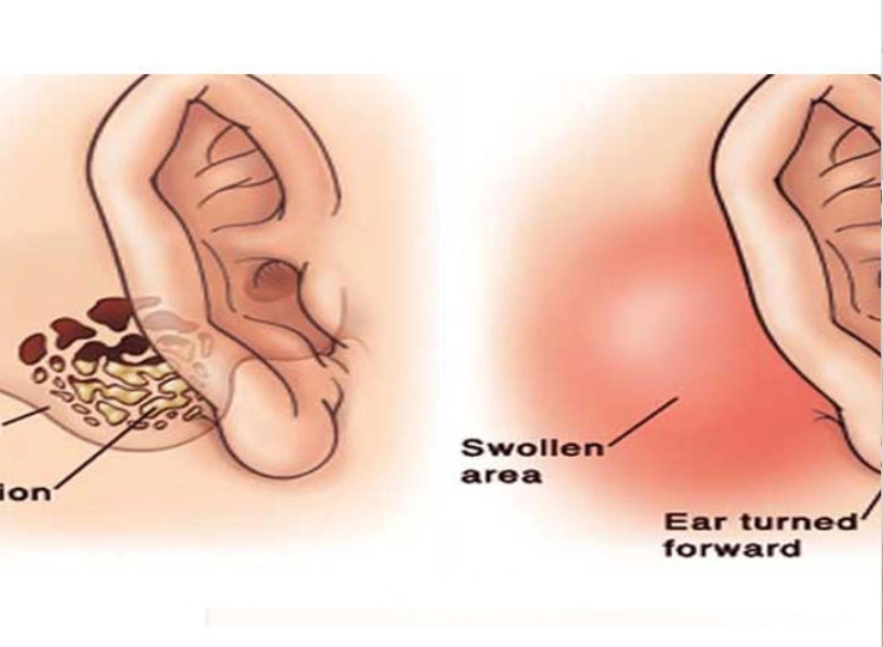 Mastoidectomy Step 3