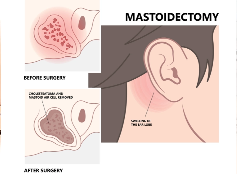Mastoidectomy Step 2
