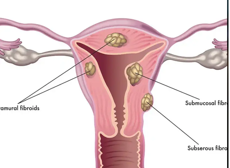 Uterine Diagnosis