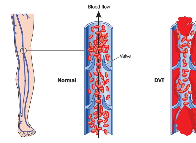 DVT Step 4