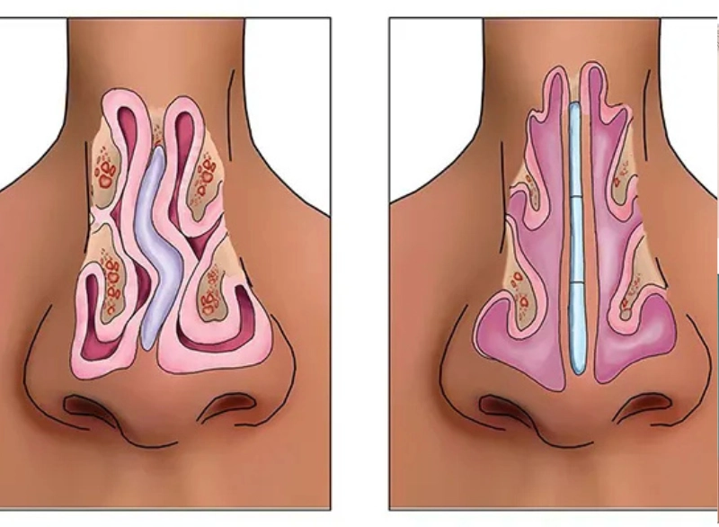 Septoplasty Step 4