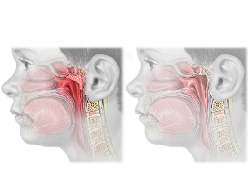 Adenoidectomy Step 4