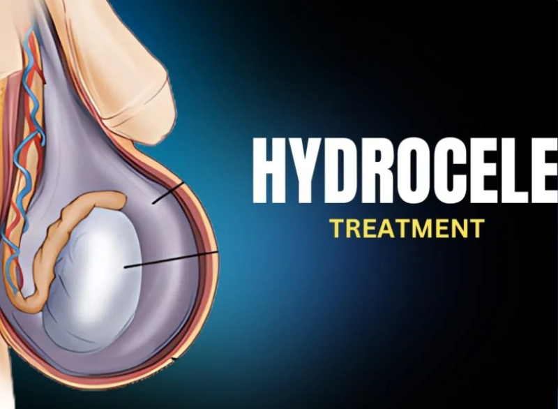 Hydrocele Step 1