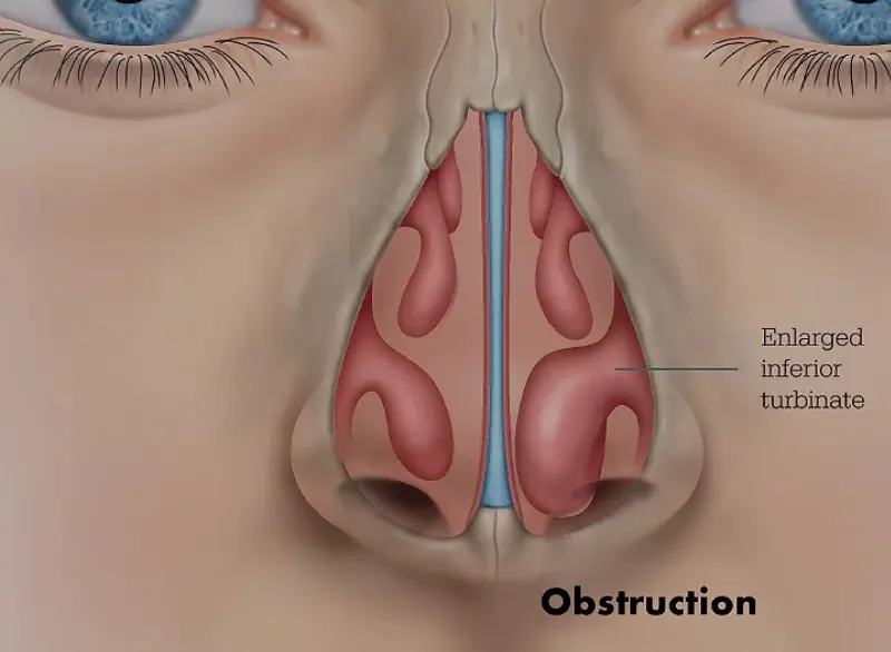 Turbinate Reduction step 1