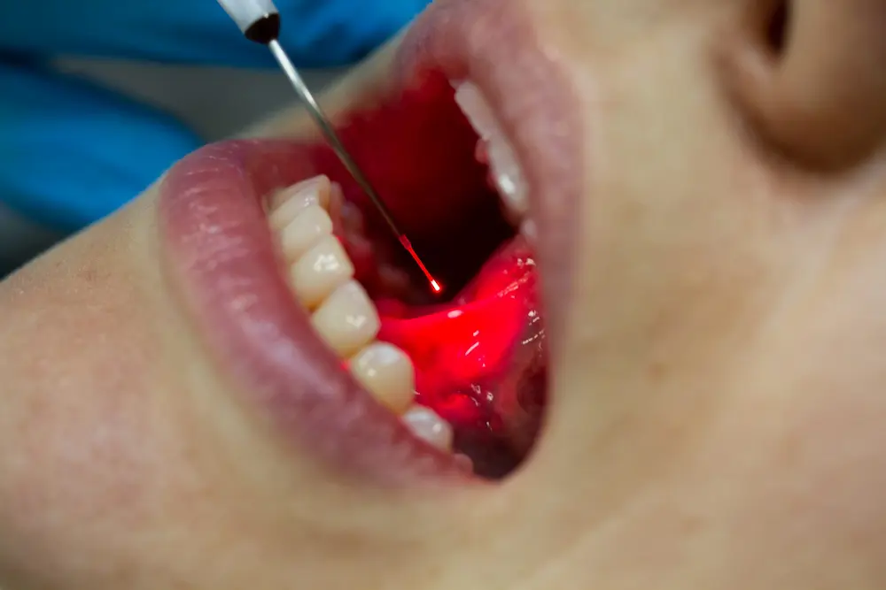 Frenuloplasty surgery