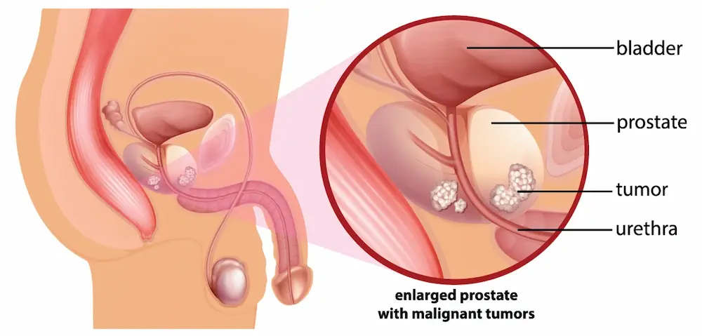 Prostatectomy Feature