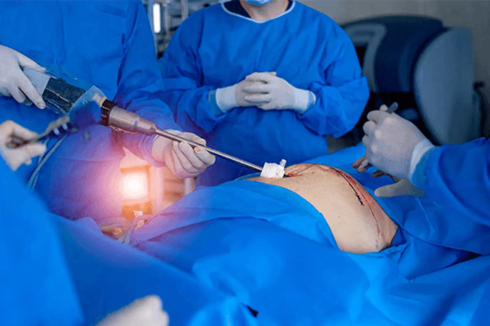 KidneyStone Cystolithotomy Step 2