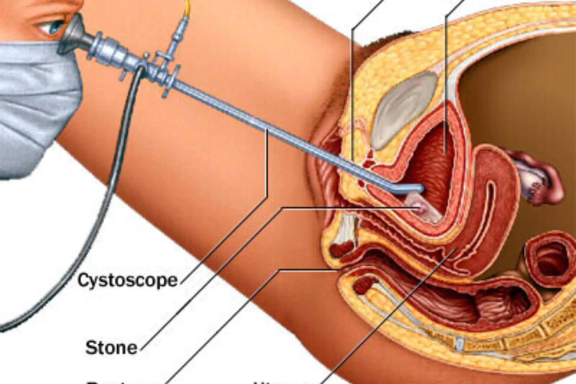 KidneyStone Cystolithotomy step 3
