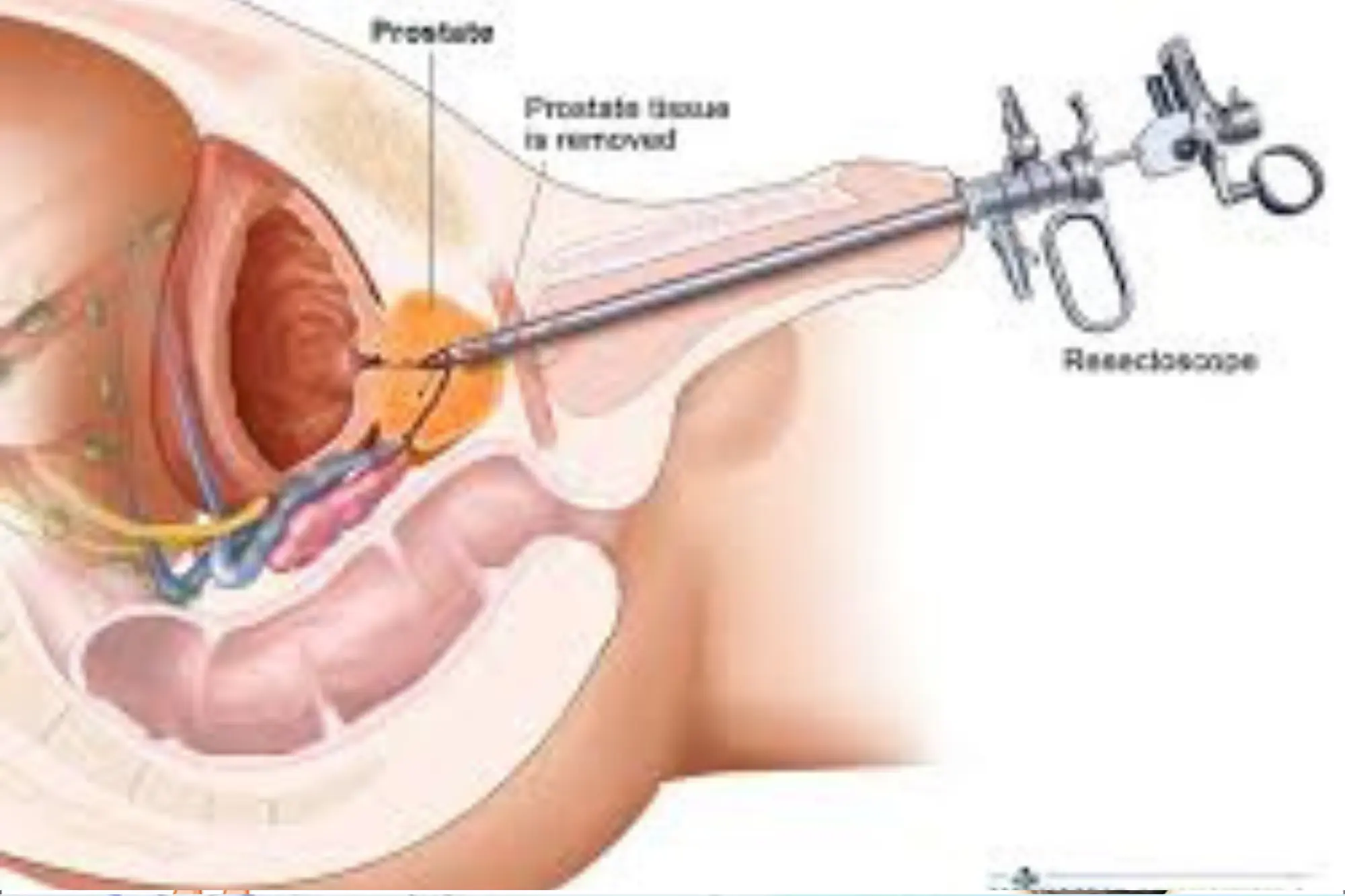 Kidney Stone BPH Step 3