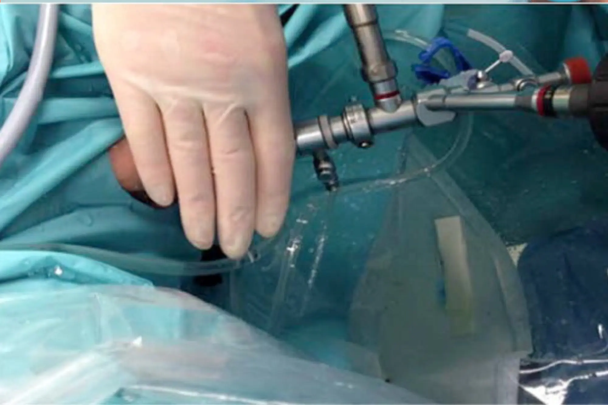 KidneyStone Cystolithotripsy Step 3