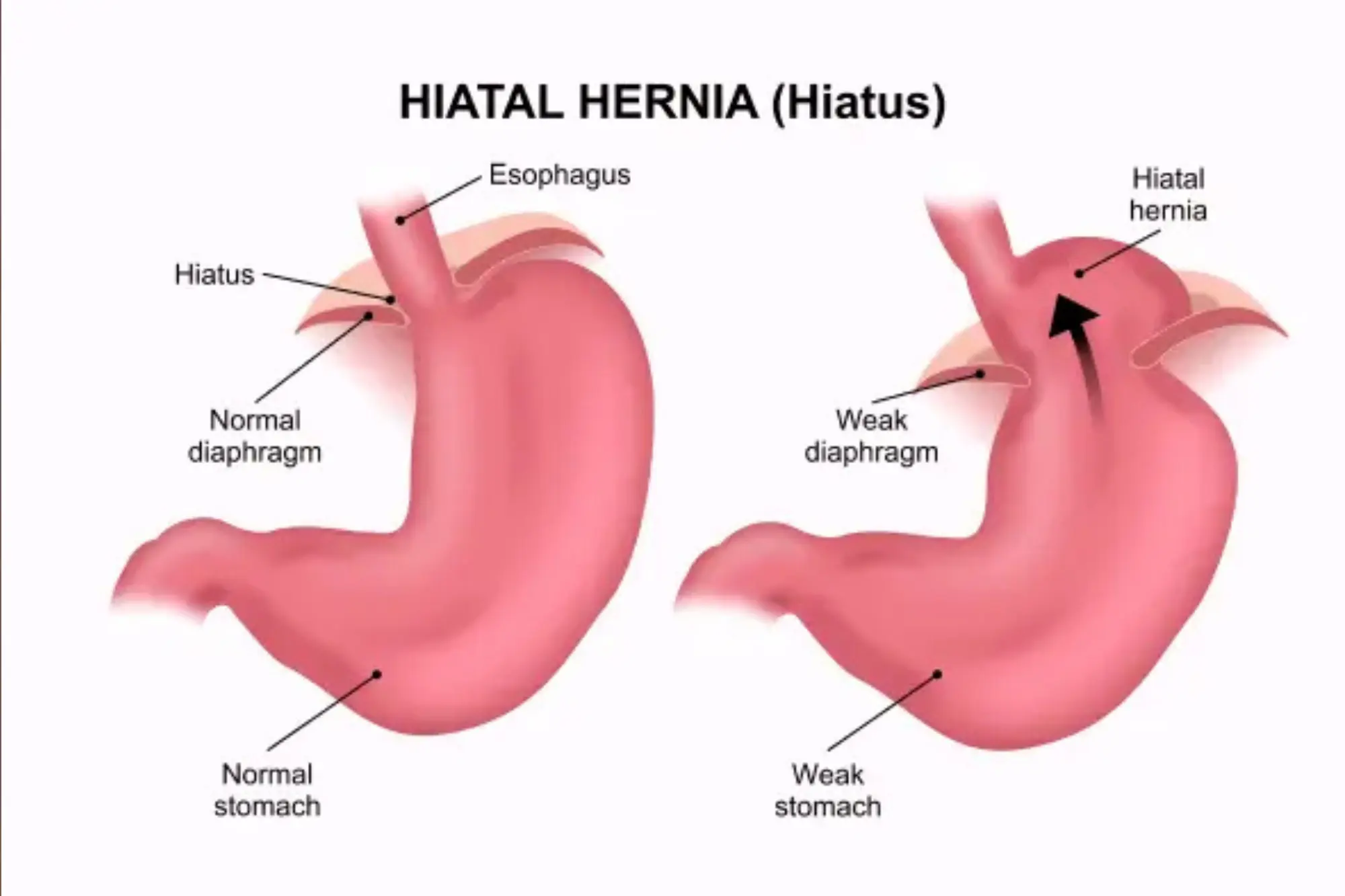 Hiatal Hernia Lowcost Surgicals Hiatal Hernia Lowcost Surgicals
