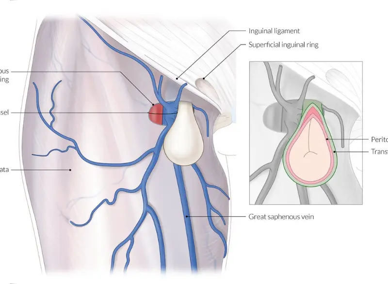 Femoral hernia Step 1