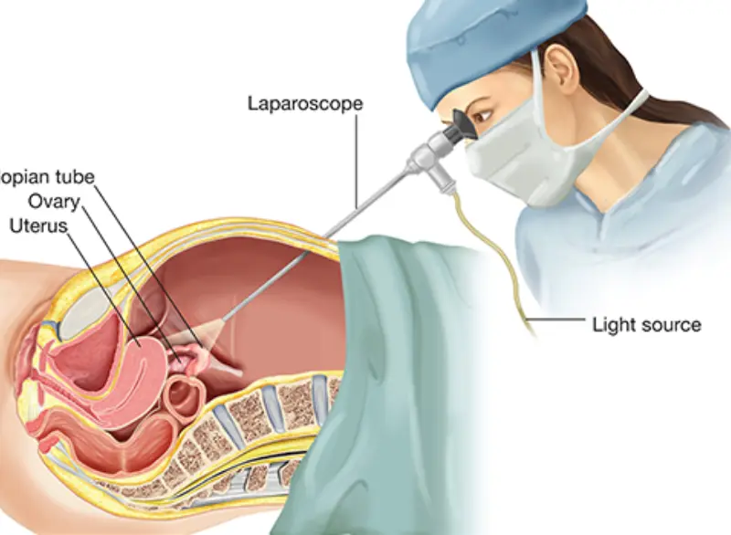 Femoral hernia step 3