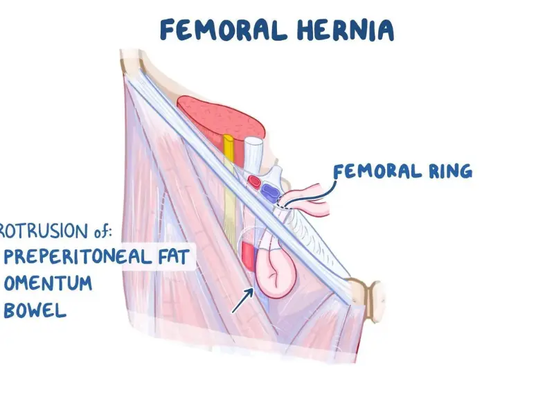 Femoral hernia step 4