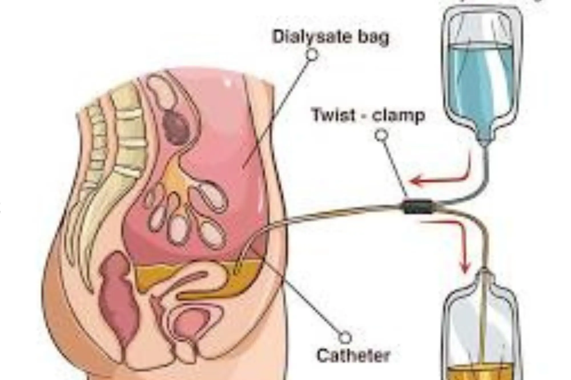 Kidney Stone OIU/VIU Step 2
