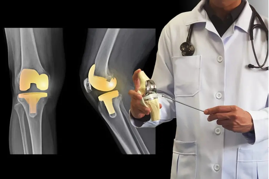TKR Bilateral Step 1