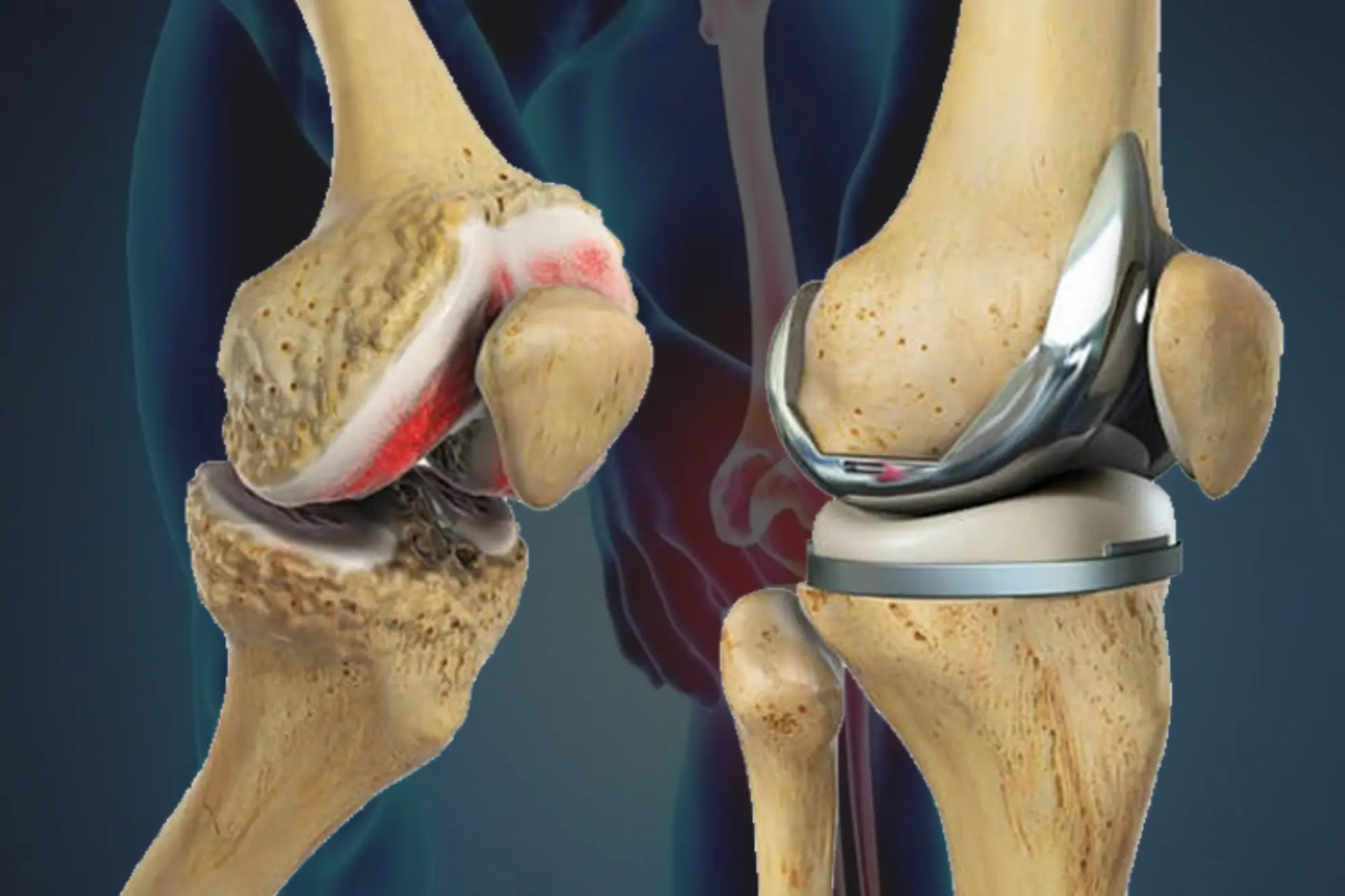 TKR Knee Replacement Step 2